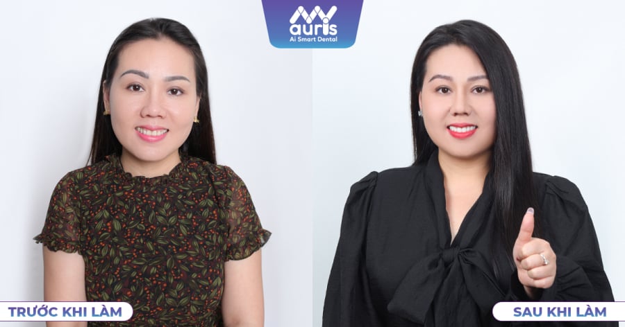 Lưu Ánh Loan trước và sau khi làm răng sứ tại nha khoa My Auris