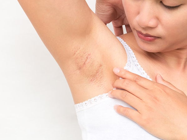 Nếu da có vết thương hở sau tẩy, cạo lông, bạn không nên lạm dụng tẩy da chết vật lý.