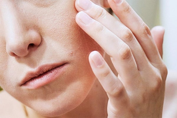 Bạn có thể dùng vaseline hoặc kem dưỡng ẩm để thoa lên những vùng da khô và nứt nẻ.