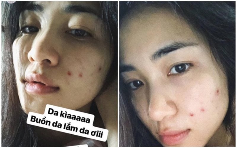 Hoà Minzy uống nước diếp cá cải thiện làn da nhiều mụn.