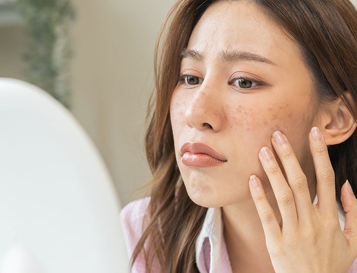 Viêm cũng có thể gây ra các đốm đen, đặc biệt là ở những người có làn da sẫm màu.