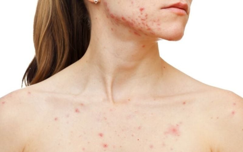 Kích ứng với những loại mỹ phẩm trang điểm, kem body, kem chống nắng cũng khiến vùng da cổ trở nên bí và gây nổi mụn.