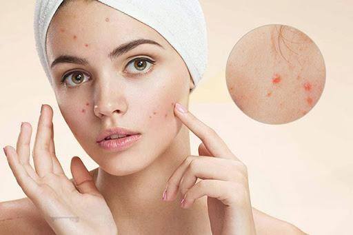 Nếu muốn có một làn da khỏe mạnh, bạn nên tránh các loại thực phẩm chế biến sẵn