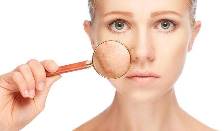 Chế độ ăn nhiều dầu mỡ có thể gây viêm nhiễm trong cơ thể, ảnh hưởng đến làn da, khiến da dễ nổi mụn