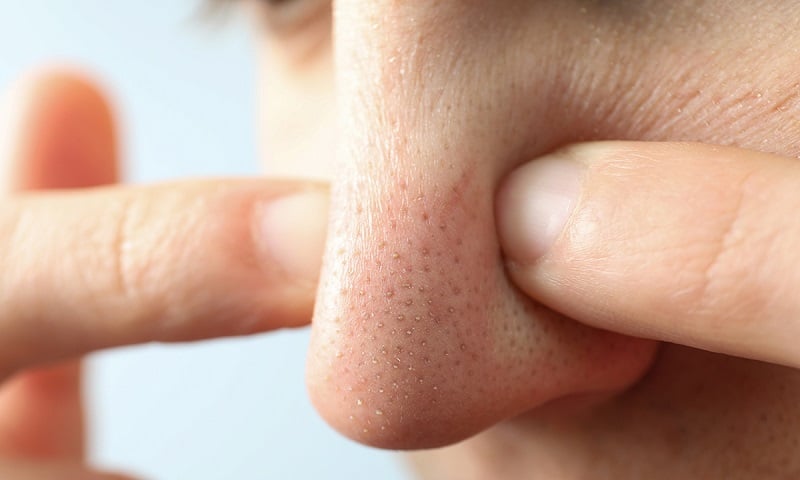 Đường và chanh tẩy tế bào chết giúp làm sạch sâu làn da và loại bỏ các tác nhân bẩn gây mụn đầu đen.