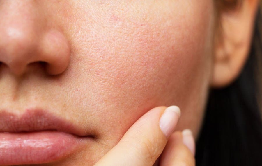 Da dầu thường khiến lỗ chân lông trông rõ hơn