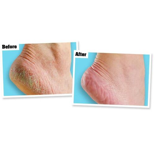Kem đặc trị nứt gót chân O'Keeffe's for Healthy Feet Foot Cream của Mỹ
