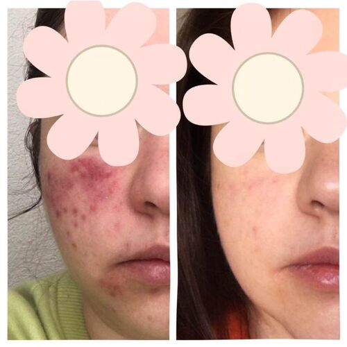 Thuốc trị sẹo Mederma Advanced Scar Gel 20 g