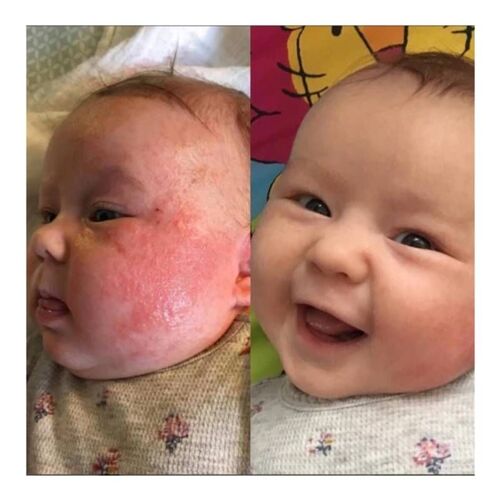 Kem đặc trị chàm sữa Aveeno Baby Eczema Therapy Moisturizing Cream 141g