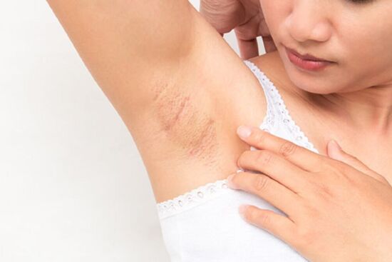 Mách nàng 7 tips đơn giản khắc phục nách bị thâm sạm, kém mịn màng