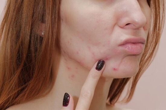 5 tác hại gây hại với làn da nếu không tránh xa mỹ phẩm hết hạn