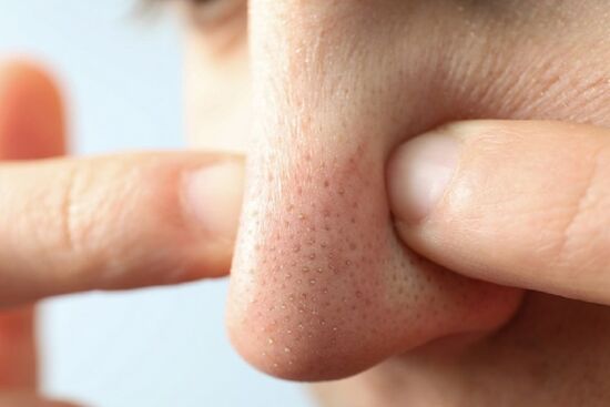 5 cách trị mụn đầu đen ở mũi bạn có thể làm bất cứ lúc nào tại nhà