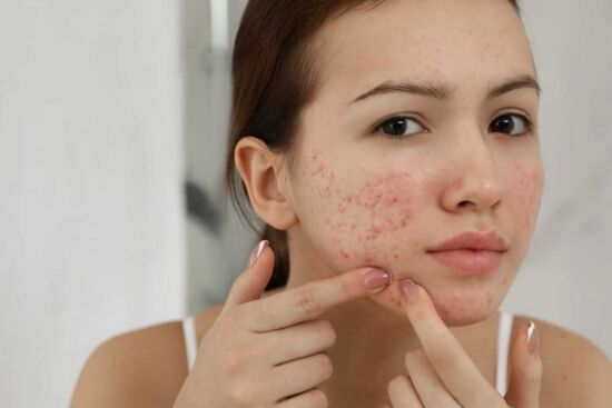 7 tips cơ bản để loại bỏ sẹo mụn đơn giản, có thể thực hiện tại nhà