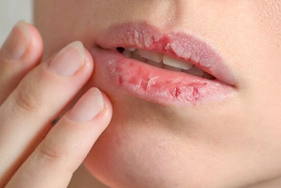 Lưu ngay những tips đơn giản cấp cứu tình trạng môi khô, bong tróc từng mảng