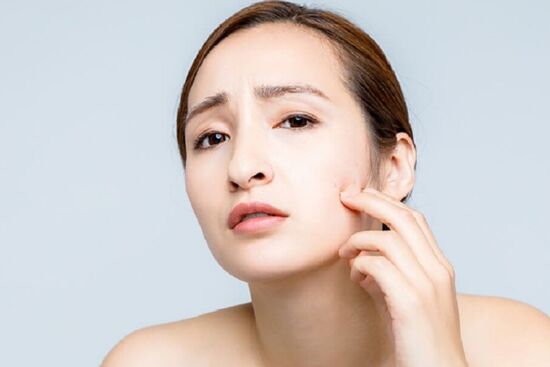 6 cách phòng mụn giảm bớt mụn ngày Tết nàng nên tham khảo
