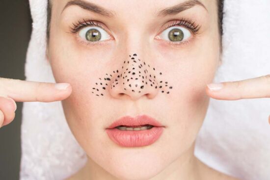 Cách trị mụn đầu đen đơn giản và hiệu quả nhất