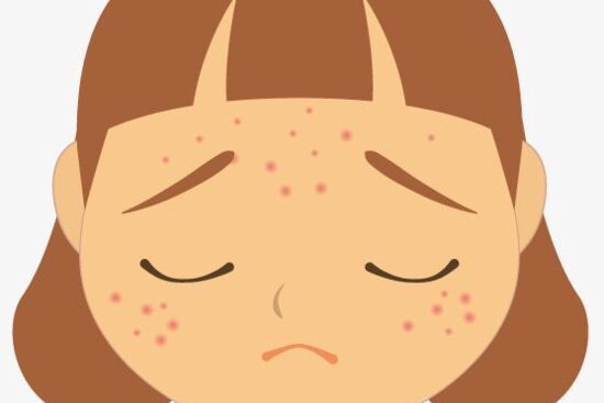 Nhận diện các loại mụn thường gặp