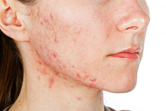 Mụn đỏ - Nguyên nhân và cách điều trị