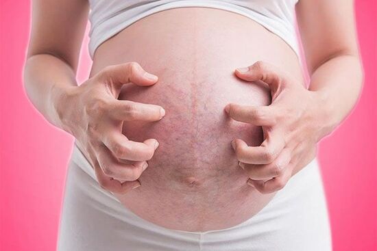 Cách phòng ngừa và trị rạn da, trị ngứa bụng, ngực khi mang thai